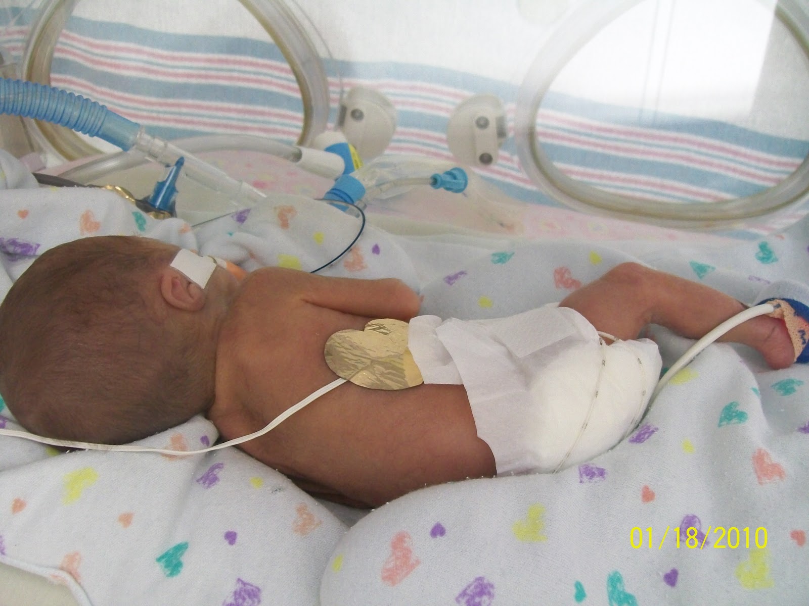 24 Weekers and Other Preemie Babies 11510 through 11810 PDA, Echo
