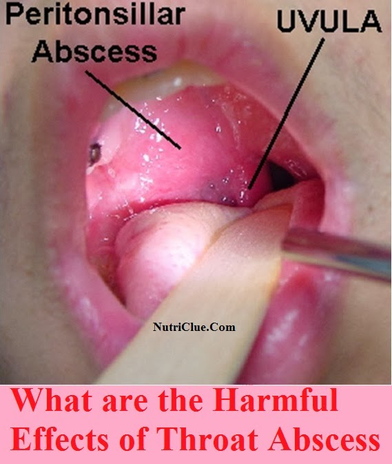 Absess In Throat 65