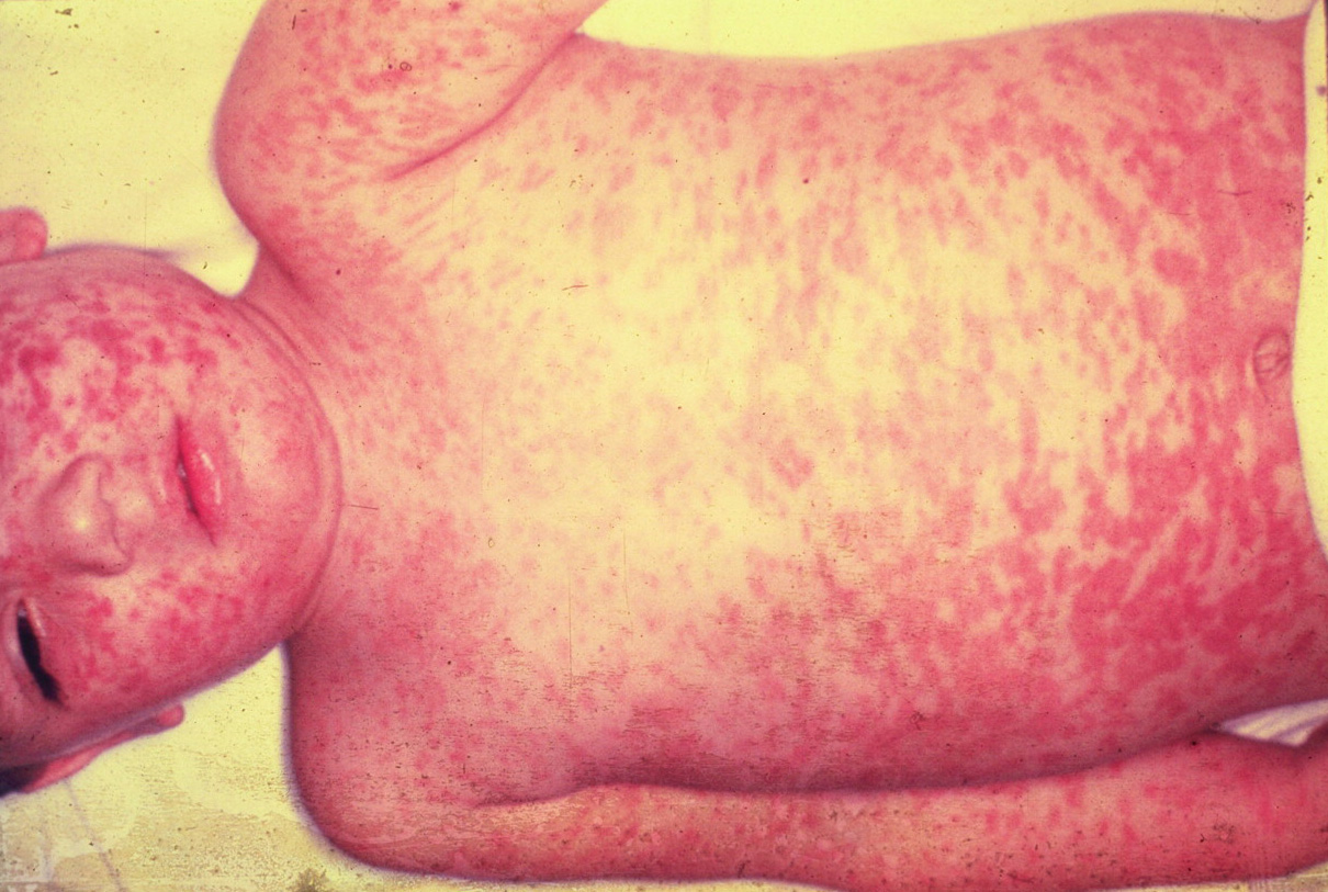 Measles Pictures