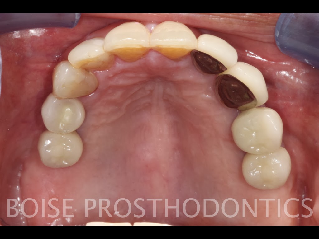 Boise Idaho Prosthodontics Maxillary Teeth and Mandibular Semiprecision Removable Partial