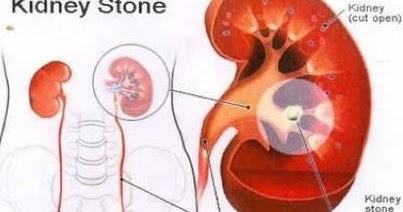 Synthroid And Severe Intestinal Gas