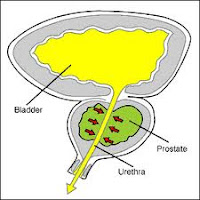 Penyakit Prostat