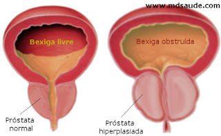 Hiperpalsia da próstata