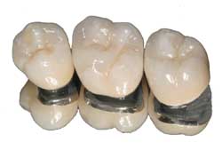 PFM crown Porcelain fused to metal crown for second premolar and molars