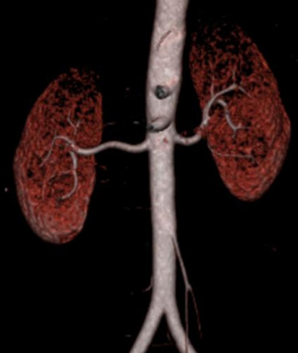 ct renal angiography radiopaedia