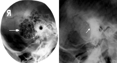 Mastoids x ray positioning