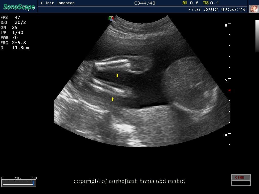 Nurhafizah Hanis Scan Details For Baby Klinik Jameaton Sri Kembangan
