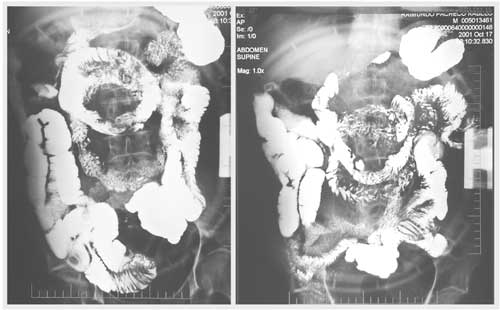 Transito intestinal exame