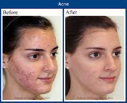 Acne No More before after