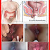 Obat Tradisional Wasir Bengkak Ampuh thumbnail