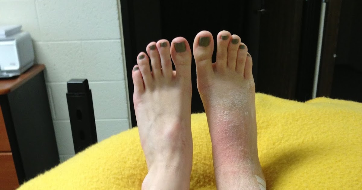 My Broken Ankle PostCast with Walking Boot