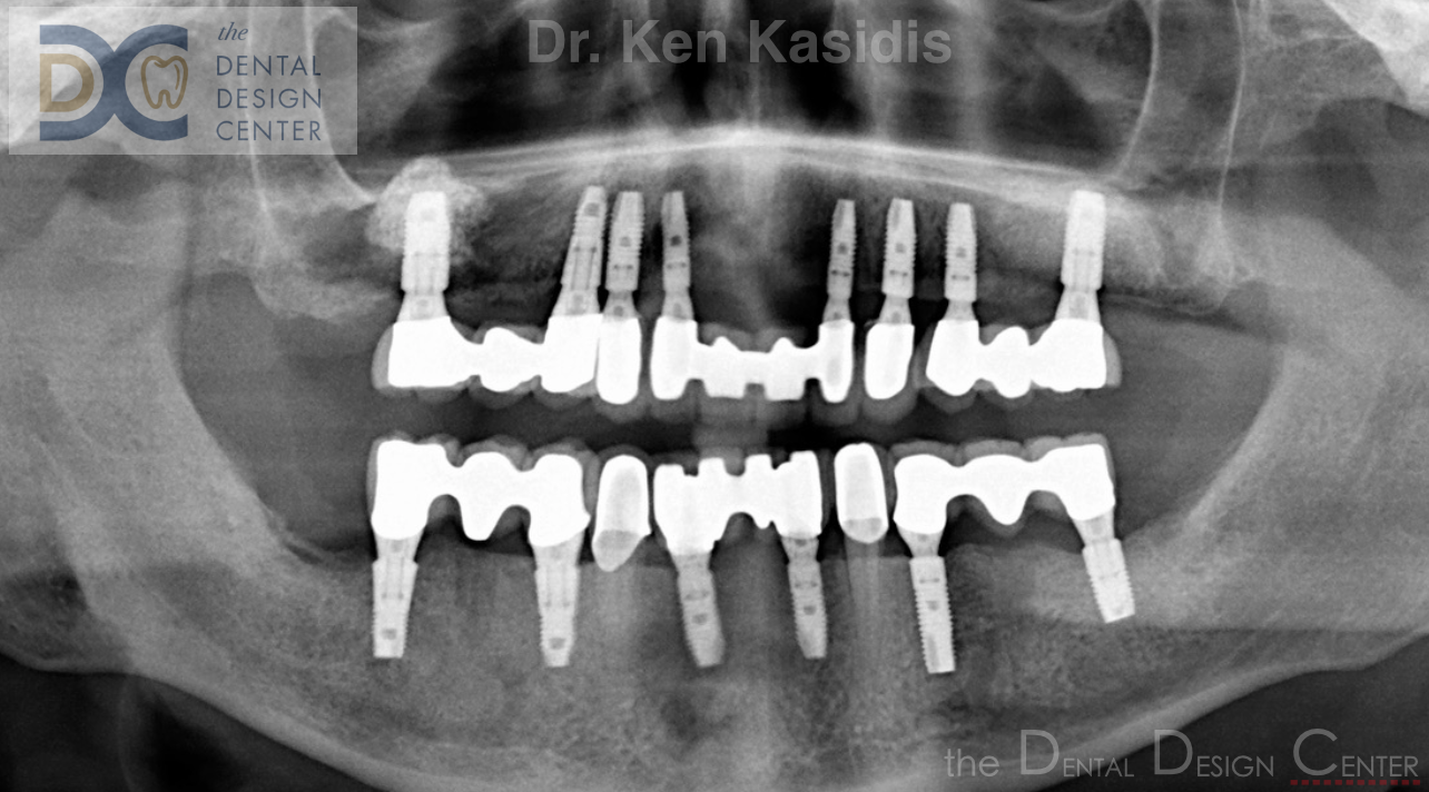 dental%2Bimplant%2Bx ray%2Bpattaya