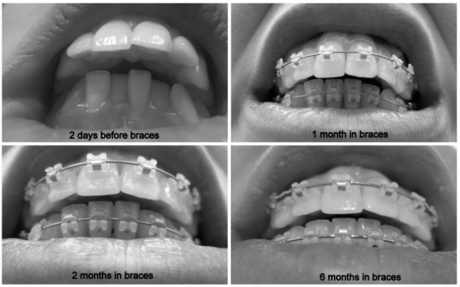 Braces Progress Photos