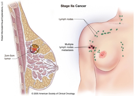 Linking risk factors and disease origins in breast cAncer