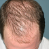 What causes Hair loss?