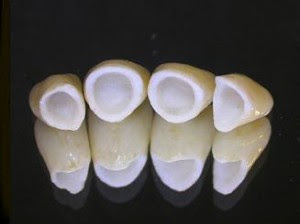 tipos de restauraciones con ceramicas dentales