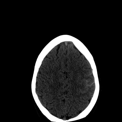 Post Gad: Trauma - Petrous Bone Fracture