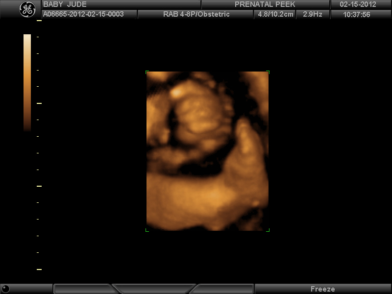 Growing Baby Gilbert 3D Ultrasound