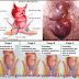 Obat Wasir Ampuh thumbnail