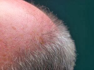 Les boutons sur la personne et le cou psikhosomatika