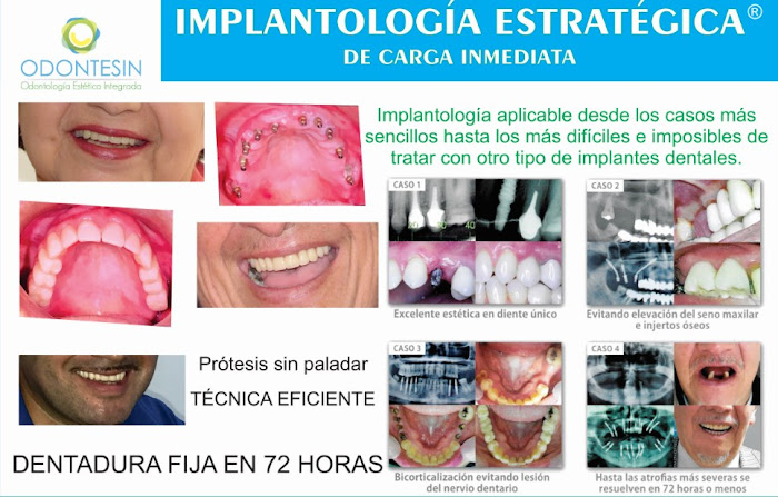 Implantología Estratégica