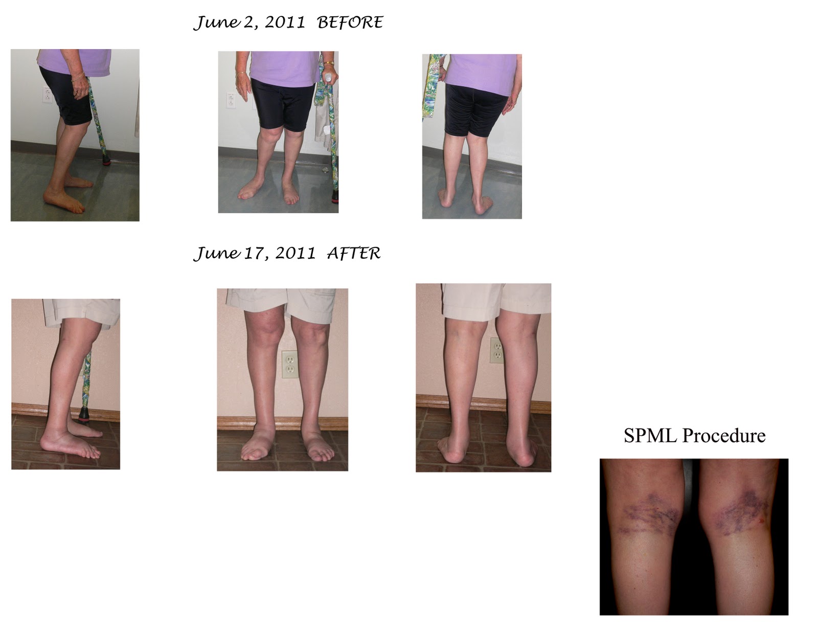Hamstring Lengthening Surgery