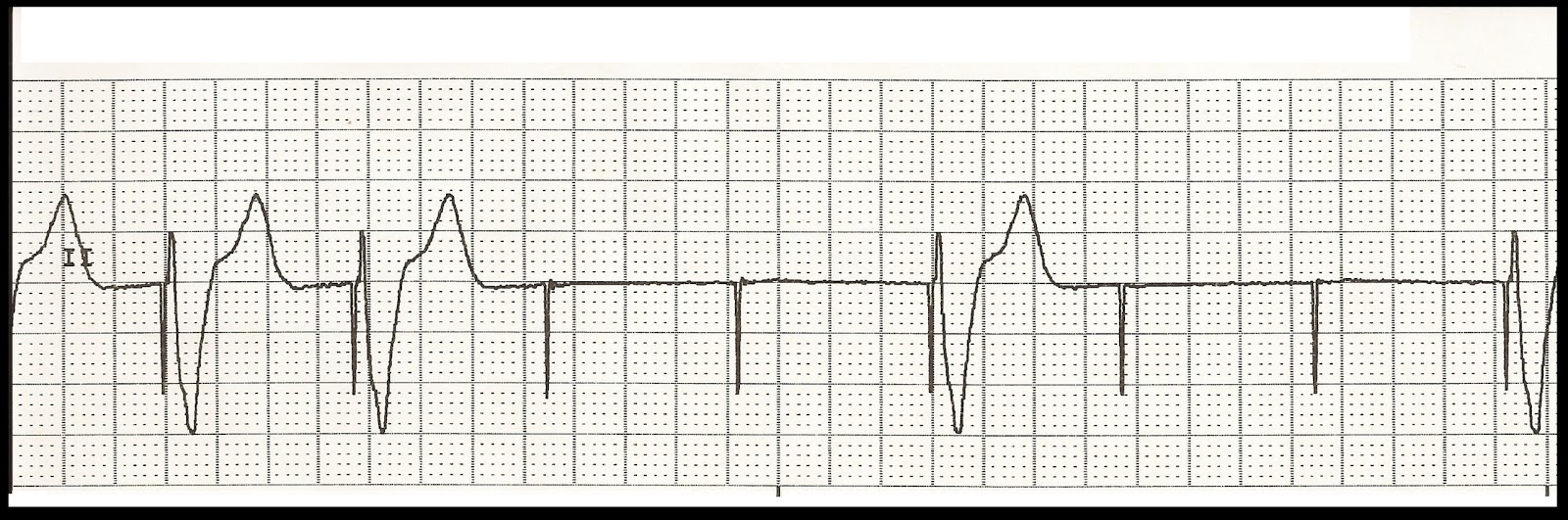 Float Nurse Unstable Bradycardia Part 3