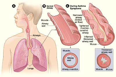 Different Normal Airways and During Asthma Symptoms