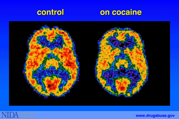 What Is A Long Term Disadvantage Of Cat Scans What Is A Long Term Disadvantage Of Cat Scans