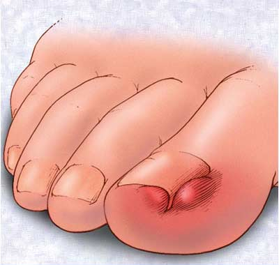 princess foot treatment of ingrown