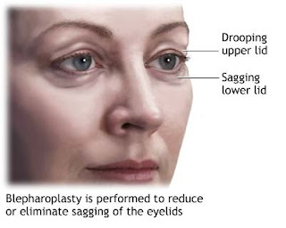 eye lid surgery before and after photos