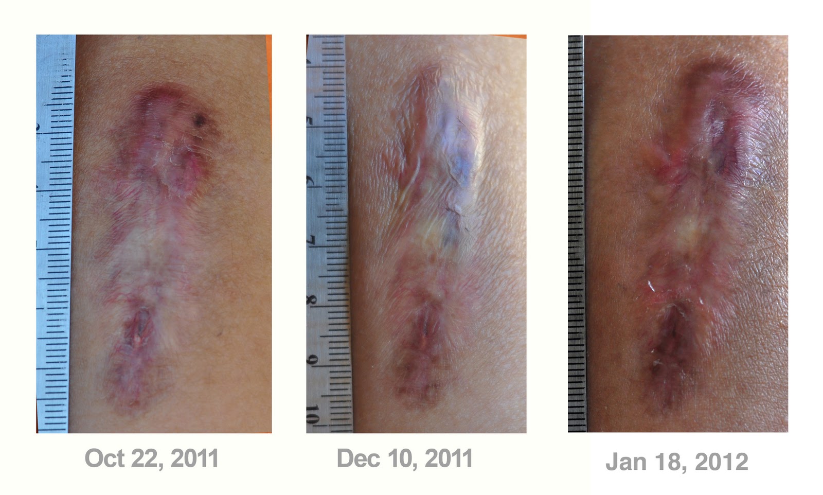 Keloid Steroid Injection