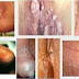 Cara Menuntaskan Kutil di Penis thumbnail