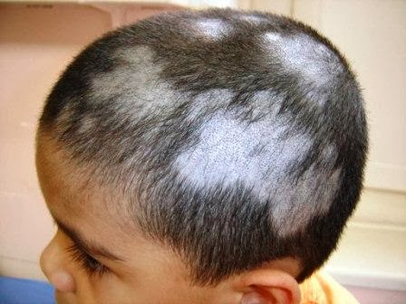 candidiase tem cura em homem