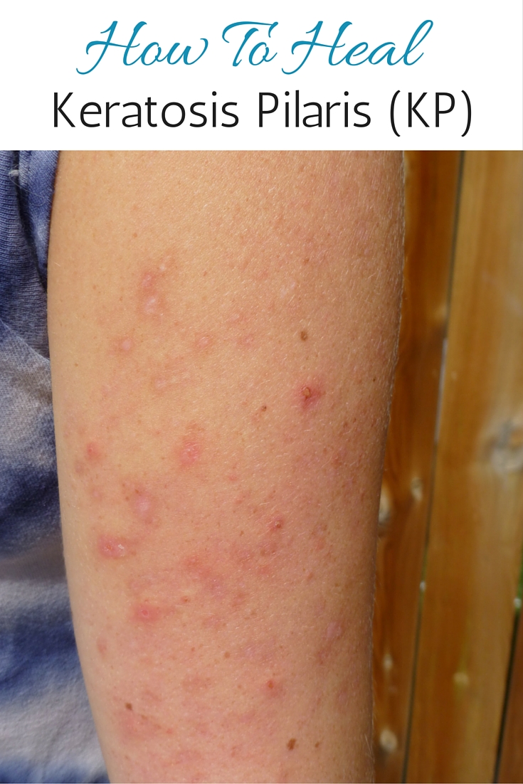 Pure and Simple Nourishment How I Healed My Keratosis Pilaris (KP