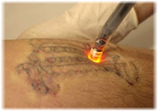 Laser+Tattoo+Removal.jpg