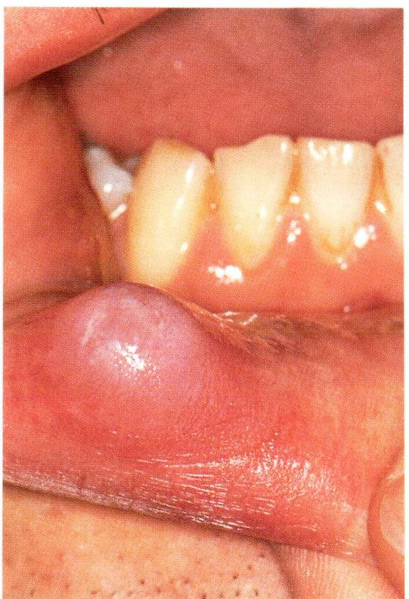 Mucocele Mouth