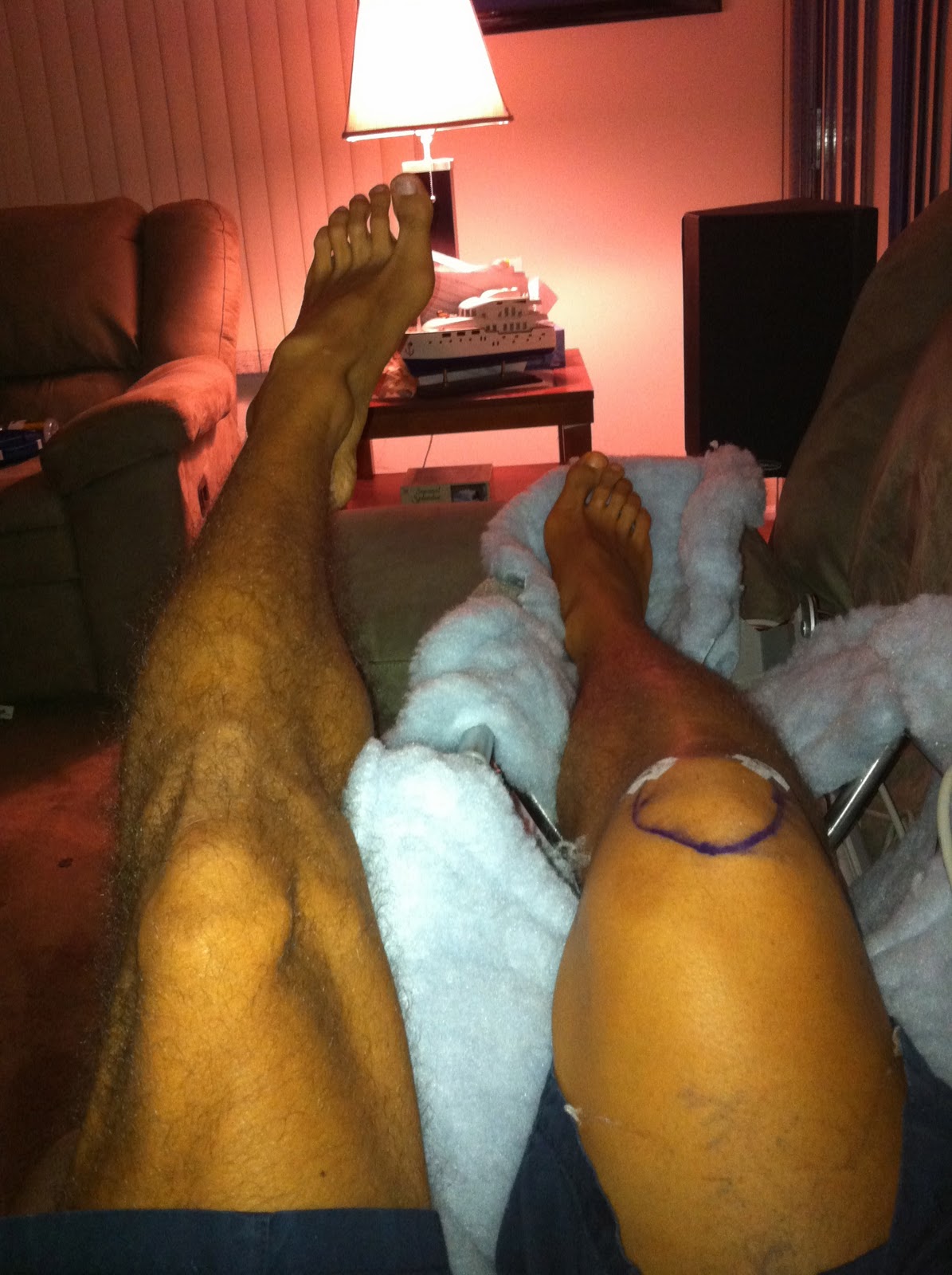 Athlete Interrupted Microfracture Surgery Explained