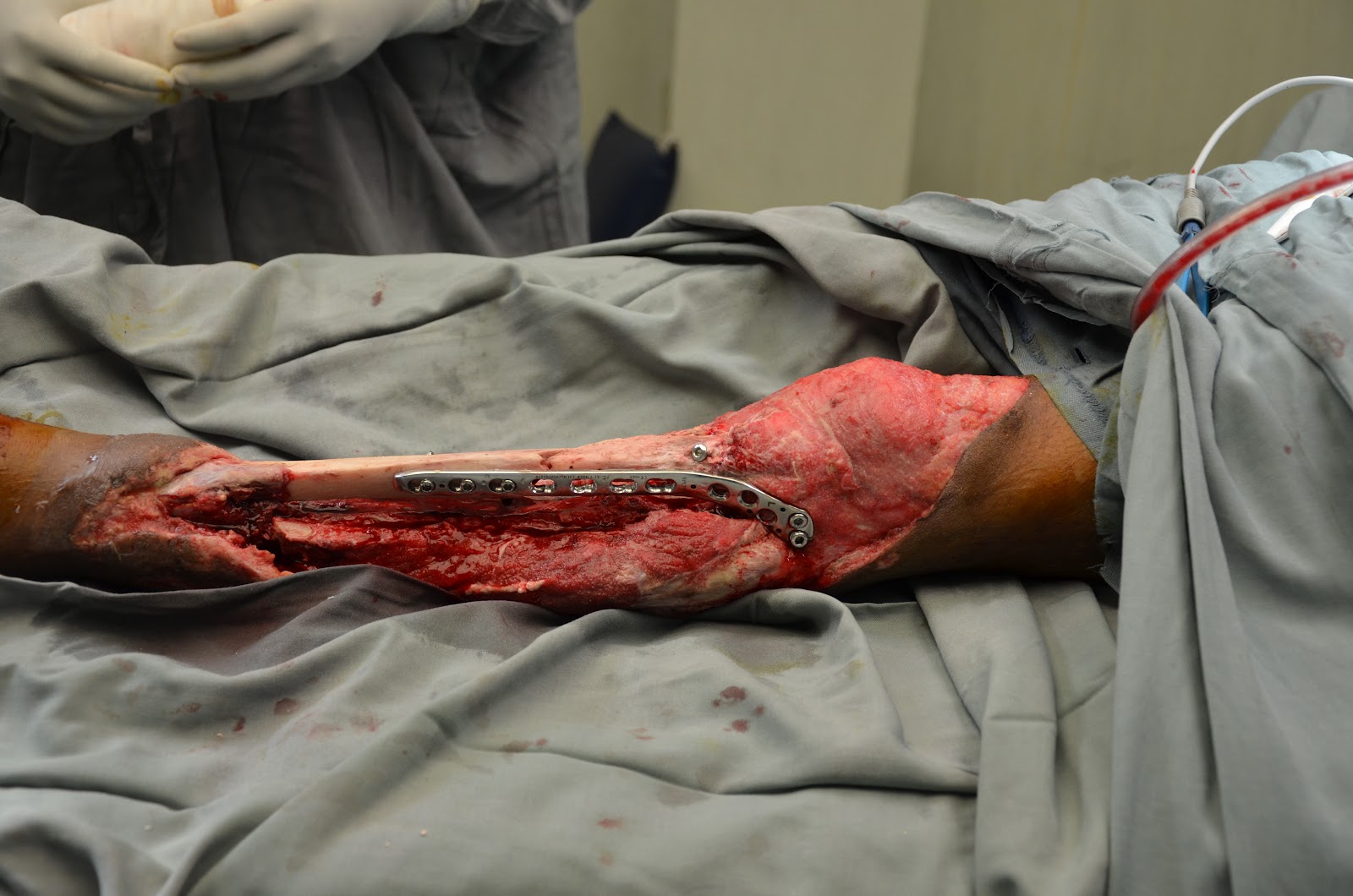 CRUSH INJURY FOOT, LOWER LIMB INJURIES AND LIMB SALVAGE: MAJOR CRUSH