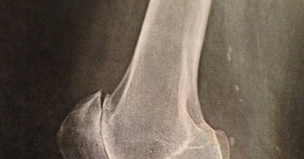 My Multiple Myeloma Journey Knee Problems