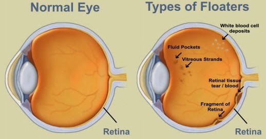 Obat Penyakit Mata Floaters Herbal  Blog Informasi Berita Terbaru