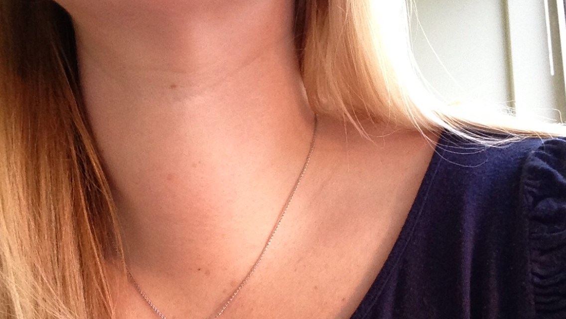 Soft Fleshy Lump On Collarbone meracp