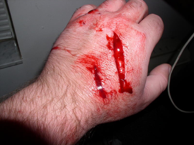 Pictures+of+Bad+Wounds so, whilst i was cooking i cut myself and i have no idea how it ...