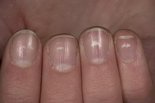 Leucinychia - White nails Leukonychia fingernail white nails