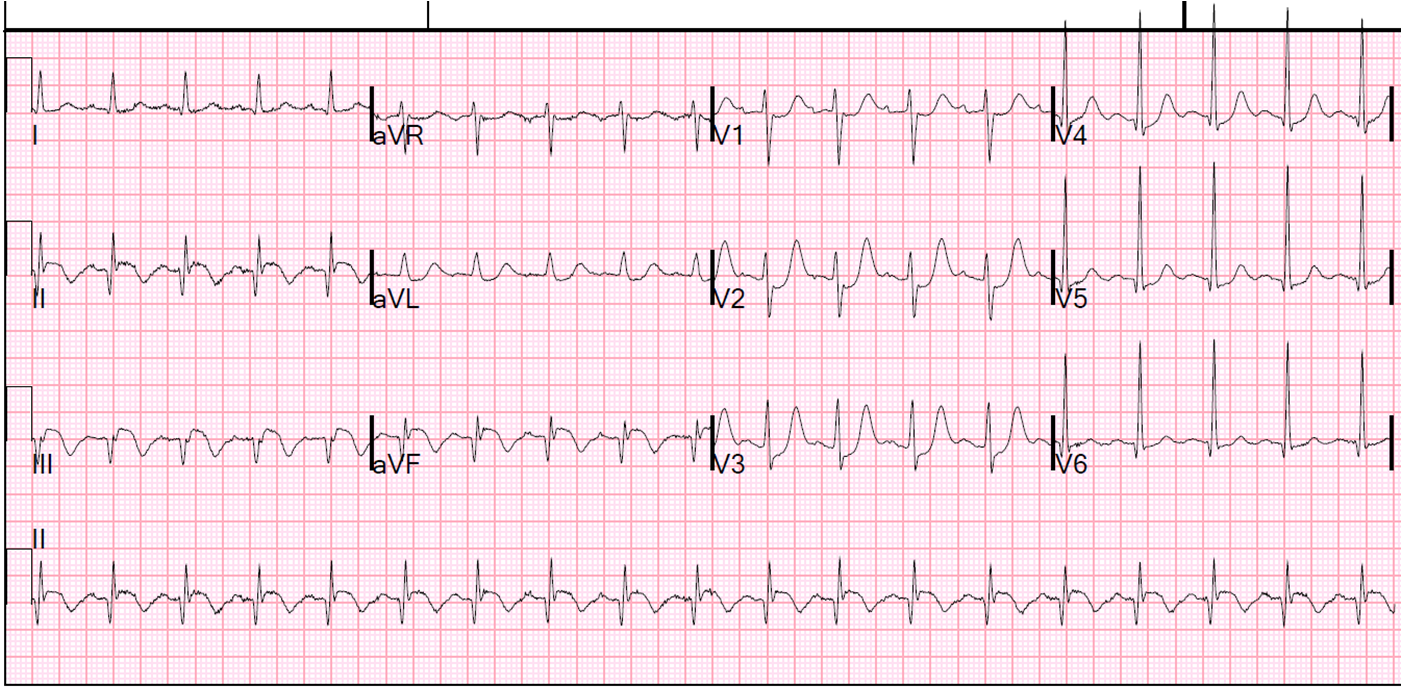 Dr. Smith's ECG Blog Chest pain and Bradycardia