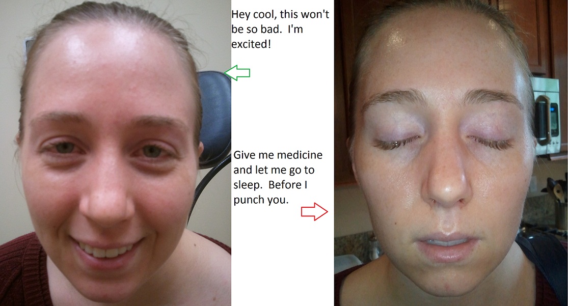 A Nose Adventure Septoplasty Day 7 Splints Out!