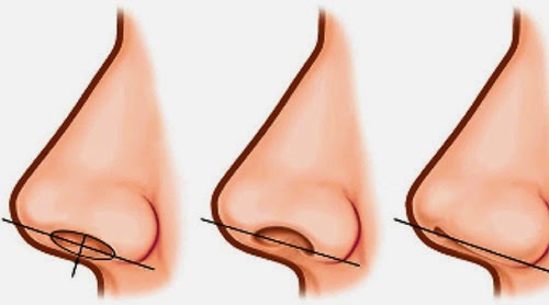 Best Sinusitis Treatment Kerala