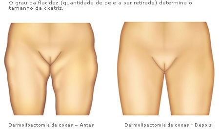 Proteína de serumal de respostas de perda de peso e resultados