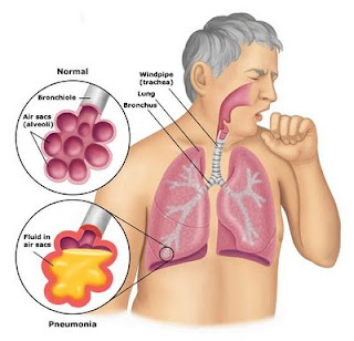 Gejala, Pengobatan dan Perawatan Pneumonia penyakit paru-paru, gejala infeksi paru paru