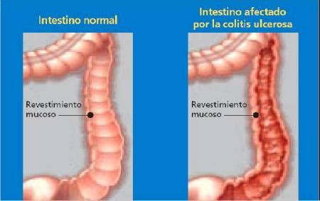 varices en el estomago